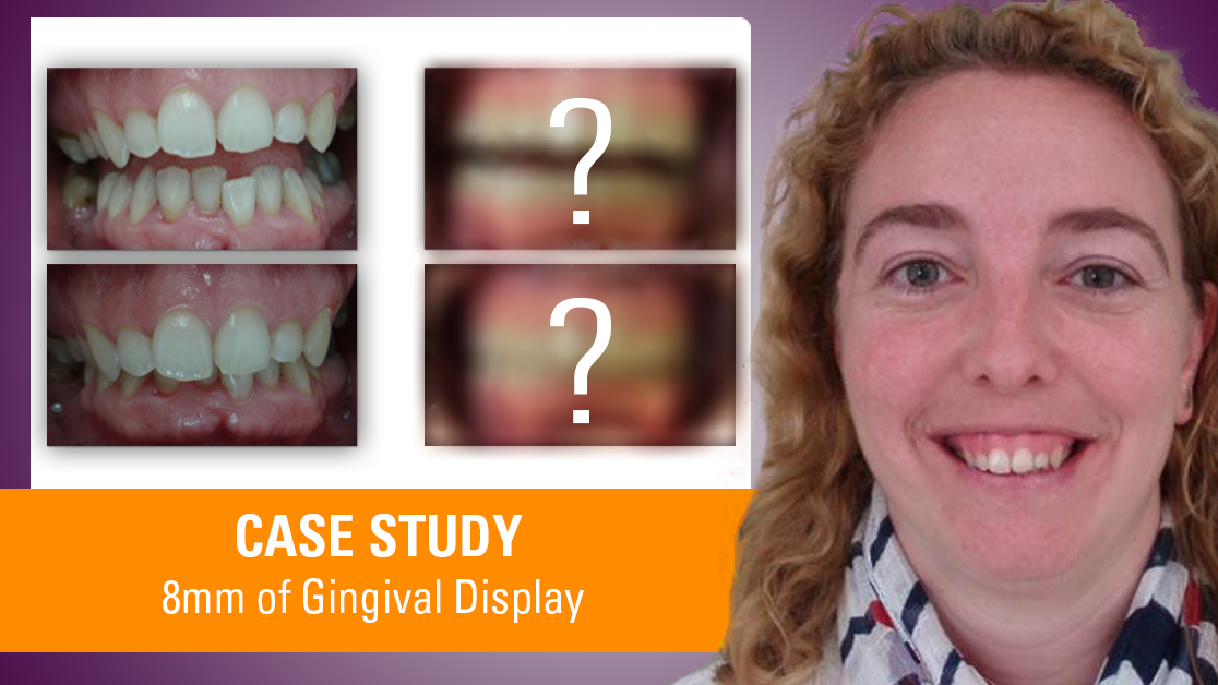 8mm Diana Gingival Display