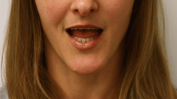 Andi Aligner GIF 2