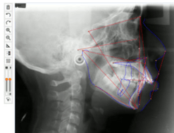 Ceph x-ray with tooth movement treatment plan