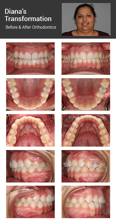 Dr. Cimino's case Diana before and after orthodontics pictures.png