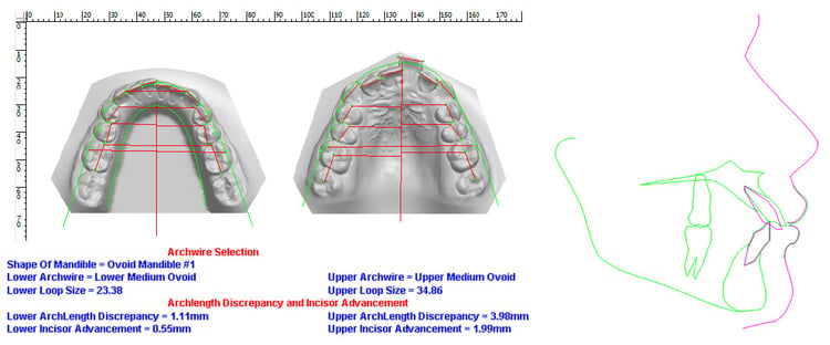 Johana-Model-Analysis-Distalization-vto.jpg