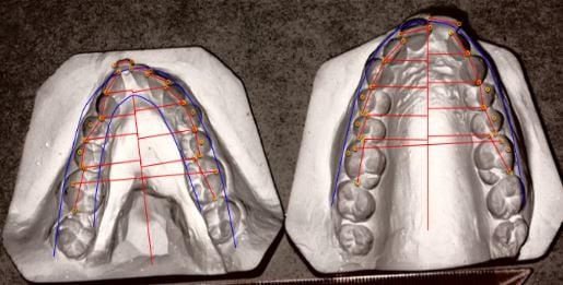 Model Measuring Planning in Asia Orthodontic Case