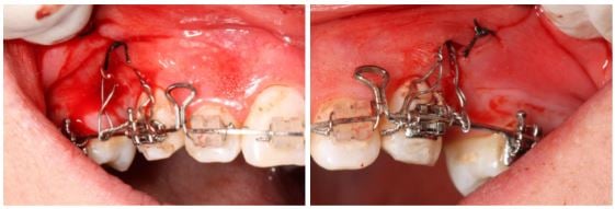 Skeletal anchorage suturing