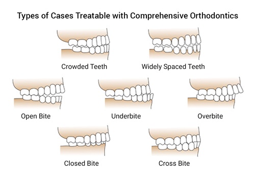 Types-of-Ortho-Cases.jpg