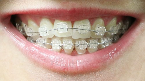 Orthodontic Appliances 101: Comparing the Most Common Types of Braces