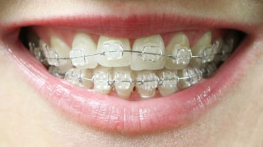 ceramic-braces.jpg