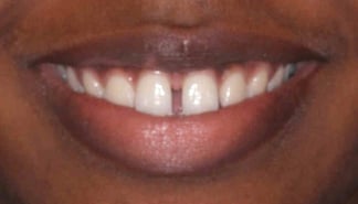 diastema