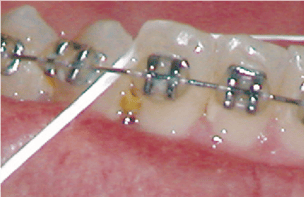food caught between teeth braces
