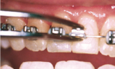 loose brackets wires or bands braces emergency