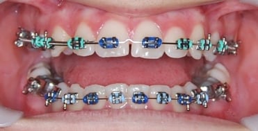 Teeth Braces – Types of Orthodontic Braces, Age Limit, Getting Dental Braces,  Food Habits