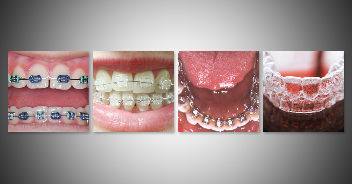 Orthodontic Appliances 101: Comparing the Most Common Types of Braces